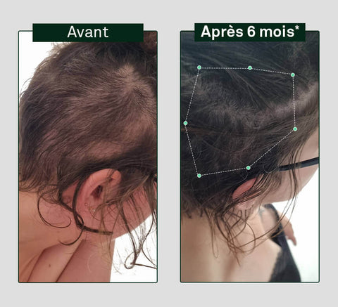 Before and after 6 months – side view hair regrowth.