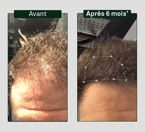 Before and after 6 months – crown density improvement.